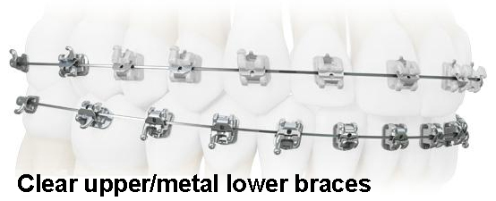 metal-clear-braces